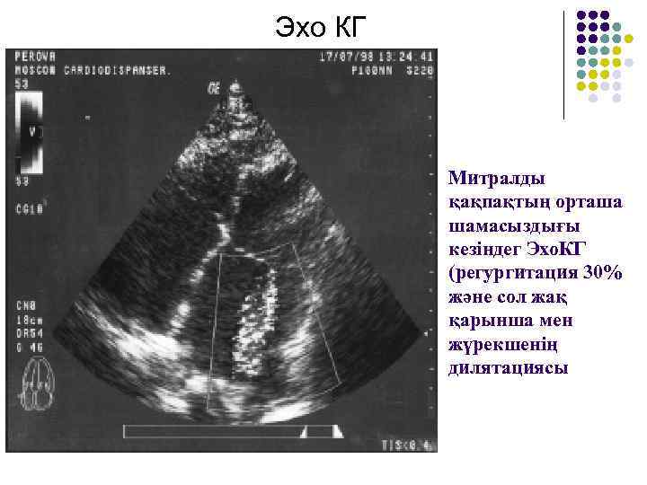 Эхо КГ Митралды қақпақтың орташа шамасыздығы кезіндег Эхо. КГ (регургитация 30% және сол жақ