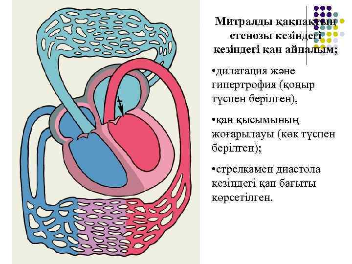 Митралды қақпақтың стенозы кезіндегі қан айналым; • дилатация және гипертрофия (қоңыр түспен берілген), •