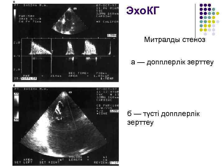 Эхо. КГ Митралды стеноз а — допплерлік зерттеу б — түсті допплерлік зерттеу 