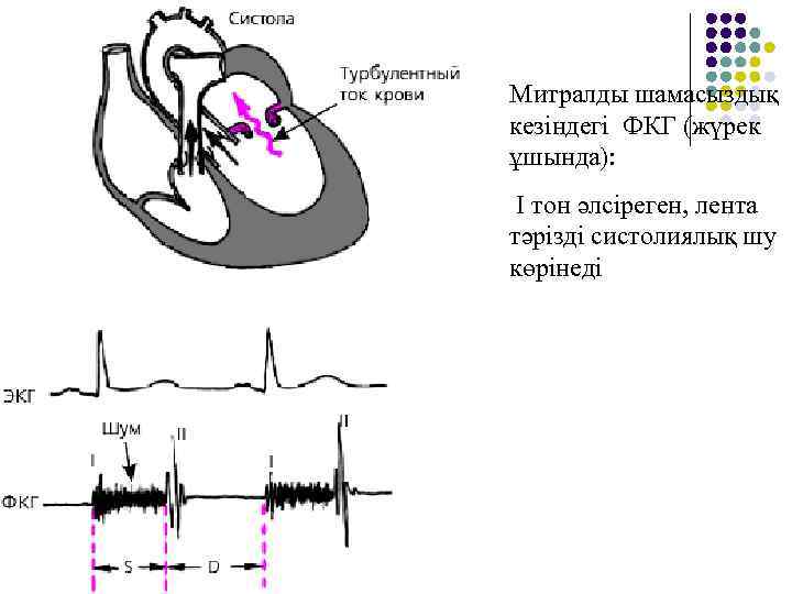 Митралды шамасыздық кезіндегі ФКГ (жүрек ұшында): І тон әлсіреген, лента тәрізді систолиялық шу көрінеді
