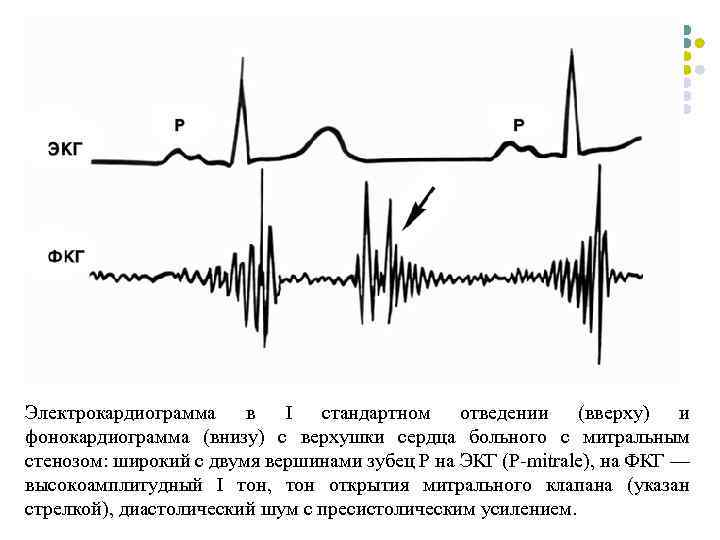 Электрокардиограмма в I стандартном отведении (вверху) и фонокардиограмма (внизу) с верхушки сердца больного с