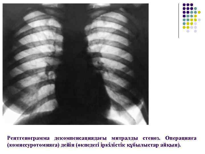 Рентгенограмма декомпенсациядағы митралды стеноз. Операцияға (комиссуротомияға) дейін (өкпедегі іркілістік құбылыстар айқын). 