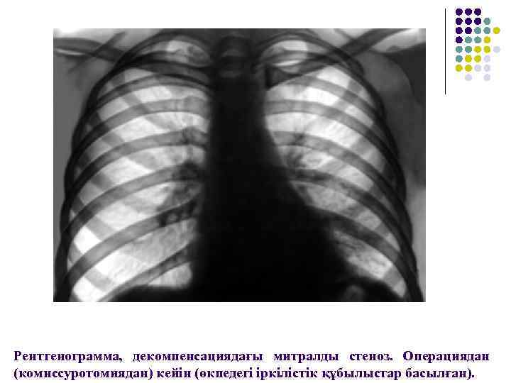 Рентгенограмма, декомпенсациядағы митралды стеноз. Операциядан (комиссуротомиядан) кейін (өкпедегі іркілістік құбылыстар басылған). 