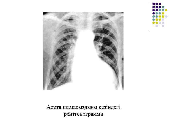 Аорта шамасыздығы кезіндегі рентгенограмма 