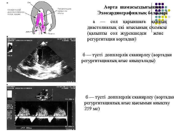 Аорта шамасыздығының Эхокардиографиялық белгілері а — сол қарыншаға қанның диастолиялық екі ағысының схемасы (қалыпты