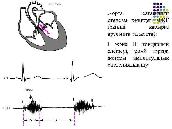 Аорта сағасының стенозы кезіндегі ФКГ (екінші қабырға аралықта оң жақта): I және II тондардың