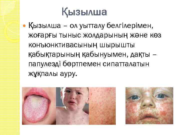 Қызылша – ол уытталу белгiлерiмен, жоғарғы тыныс жолдарының және көз конъюнктивасының шырышты қабықтарының қабынуымен,