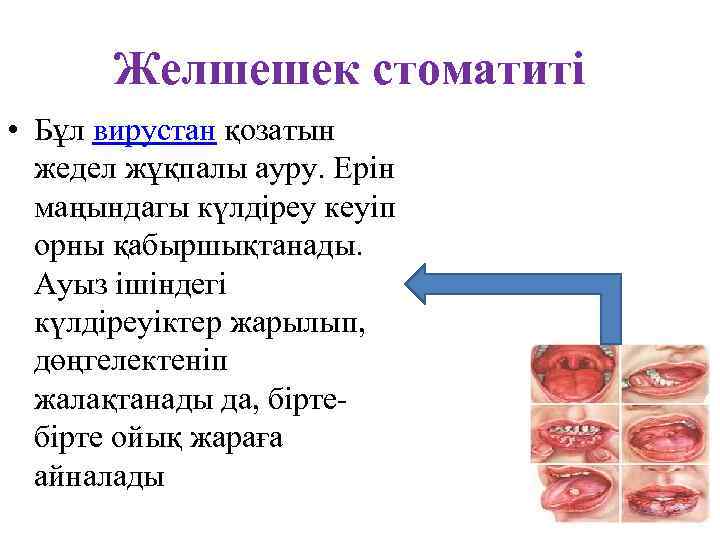 Желшешек стоматиті • Бұл вирустан қозатын жедел жұқпалы ауру. Ерін маңындагы күлдіреу кеуіп орны