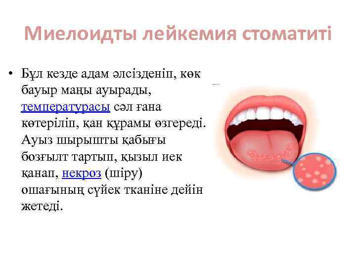 Миелоидты лейкемия стоматиті • Бұл кезде адам әлсізденіп, көк бауыр маңы ауырады, температурасы сәл