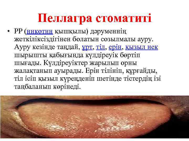 Пеллагра стоматиті • РР (никотин қышқылы) дәруменнің жеткіліксіздігінен болатын созылмалы ауру. Ауру кезінде таңдай,