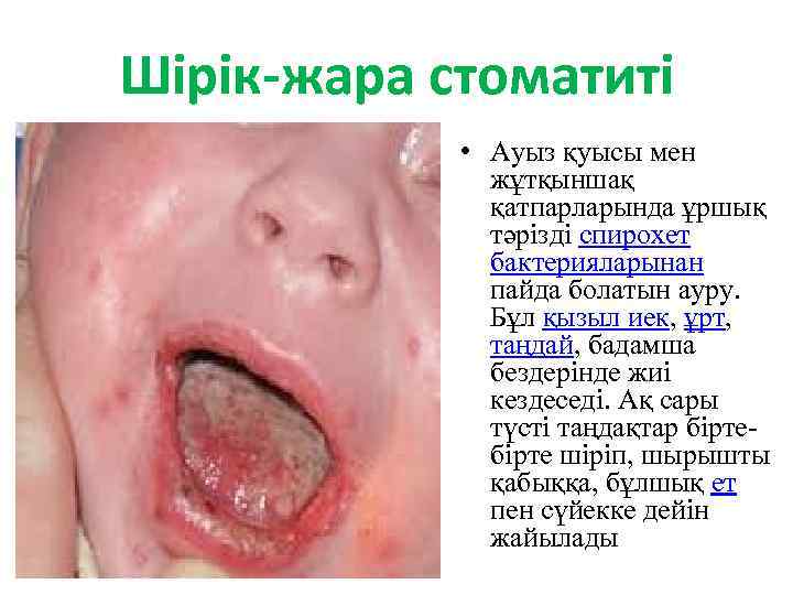 Шірік-жара стоматиті • Ауыз қуысы мен жұтқыншақ қатпарларында ұршық тәрізді спирохет бактерияларынан пайда болатын