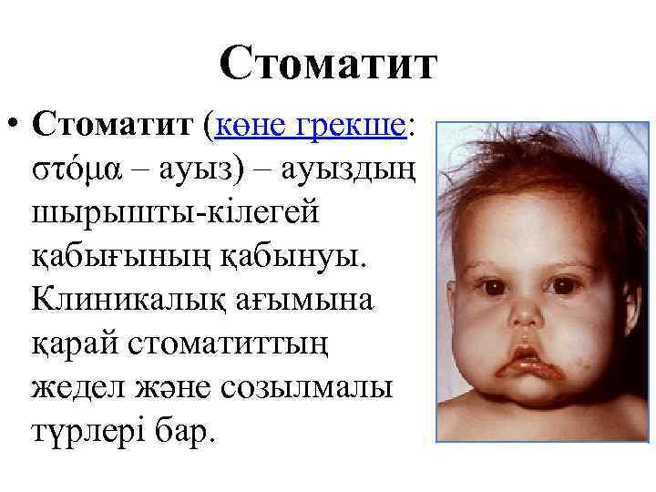Стоматит • Стоматит (көне грекше: στόμα – ауыз) – ауыздың шырышты-кілегей қабығының қабынуы. Клиникалық