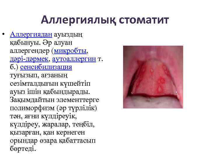 Аллергиялық стоматит • Аллергиядан ауыздың қабынуы. Әр алуан аллергендер (микробты, дәрі-дәрмек, аутоаллергин т. б.