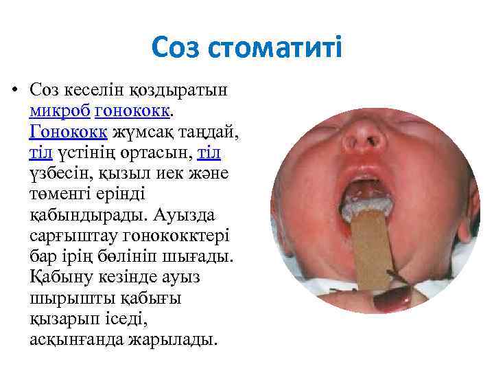 Соз стоматиті • Соз кеселін қоздыратын микроб гонококк. Гонококк жүмсақ таңдай, тіл үстінің ортасын,