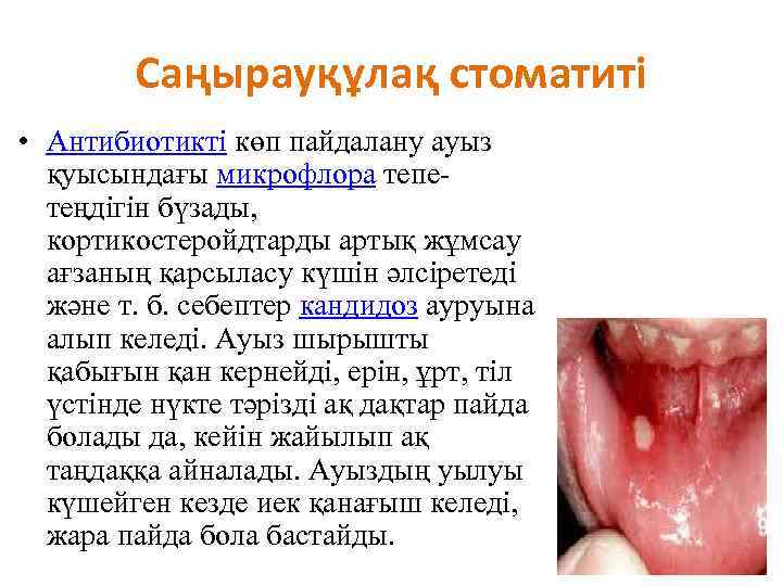 Саңырауқұлақ стоматиті • Антибиотикті көп пайдалану ауыз қуысындағы микрофлора тепетеңдігін бүзады, кортикостеройдтарды артық жұмсау