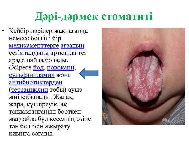 Дәрі-дәрмек стоматиті • Кейбір дәрілер жақпағанда немесе белгілі бір медикаменттерге ағзаның сезімталдығы артқанда тез