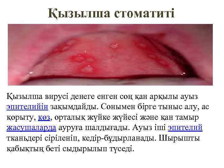 Қызылша стоматиті Қызылша вирусі денеге енген соң қан арқылы ауыз эпителийін зақымдайды. Сонымен бірге