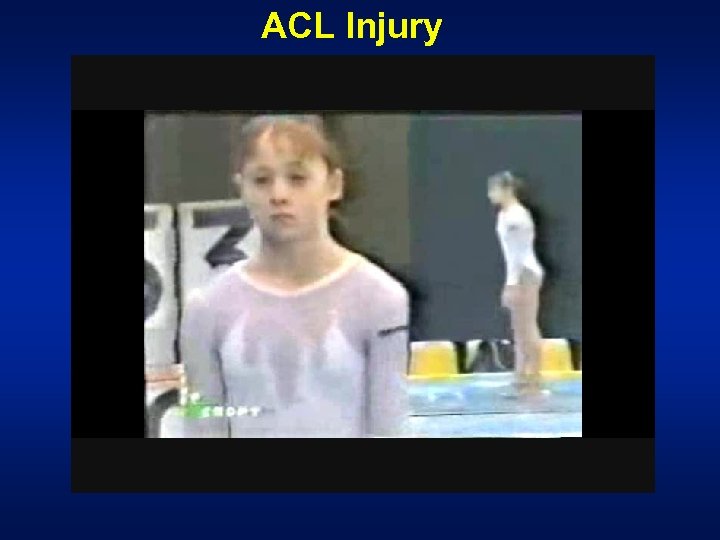 ACL Injury 