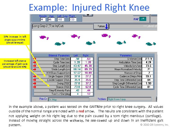 Example: Injured Right Knee 10% increase in left single support time (should be equal)