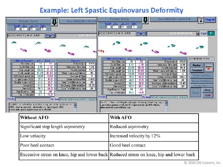 Example: Left Spastic Equinovarus Deformity © 2010 CIR Systems, Inc. 