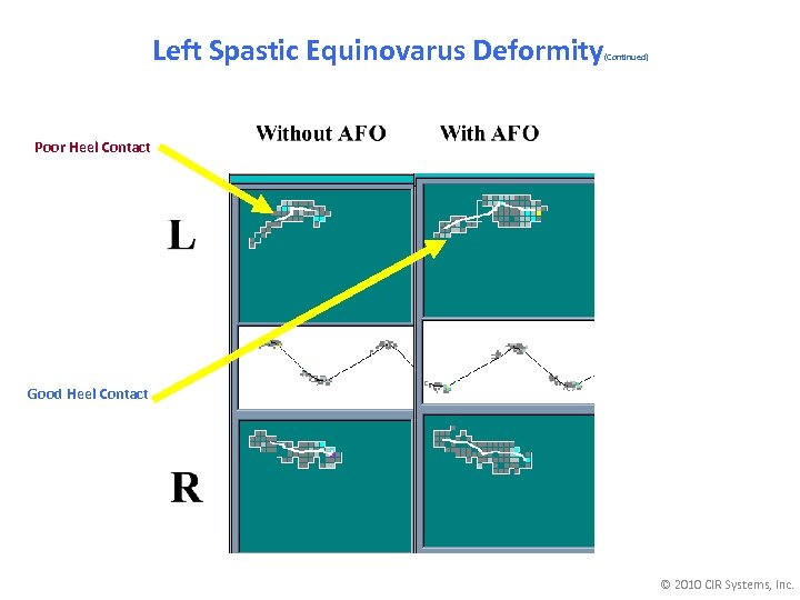 Left Spastic Equinovarus Deformity (Continued) Poor Heel Contact Good Heel Contact © 2010 CIR