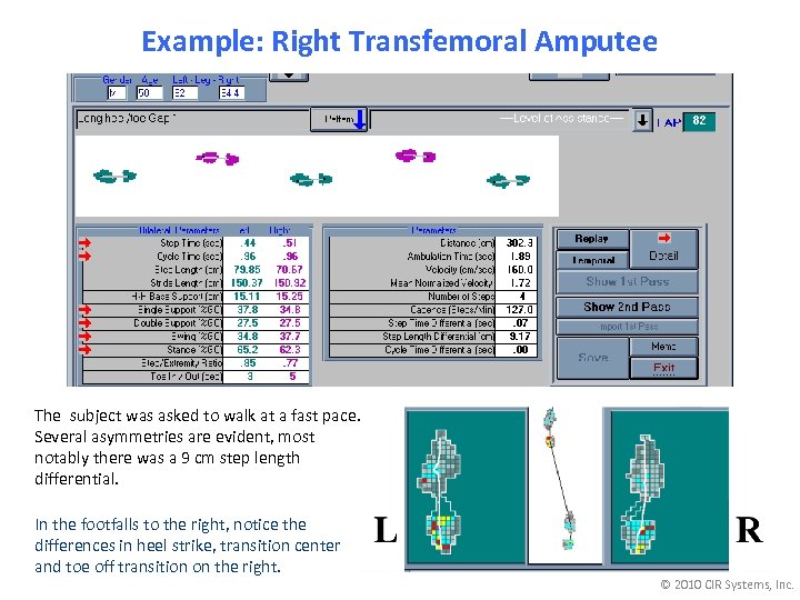 Example: Right Transfemoral Amputee The subject was asked to walk at a fast pace.