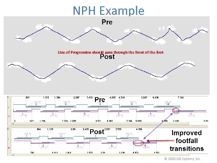 NPH Example Line of Progression should pass through the front of the foot ©