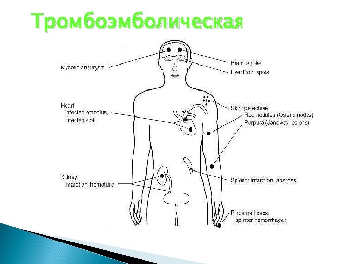 Тромбоэмболическая 