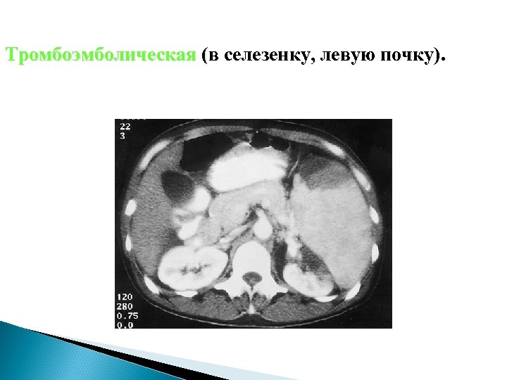 Тромбоэмболическая (в селезенку, левую почку). 