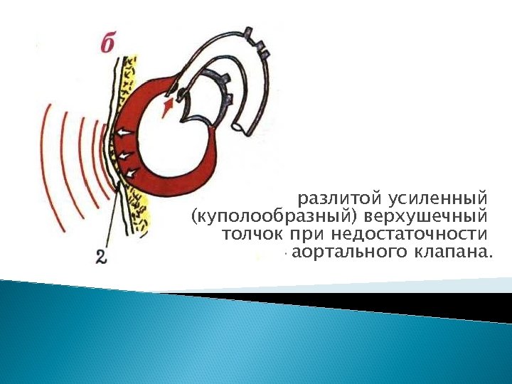 разлитой усиленный (куполообразный) верхушечный толчок при недостаточности аортального клапана. 