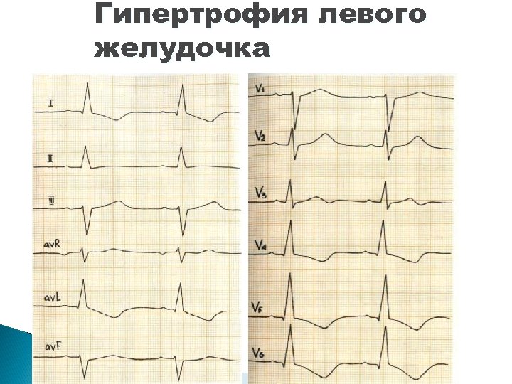 Гипертрофия левого желудочка 