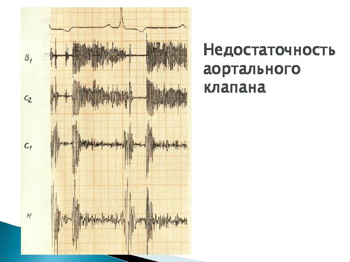 Недостаточность аортального клапана 