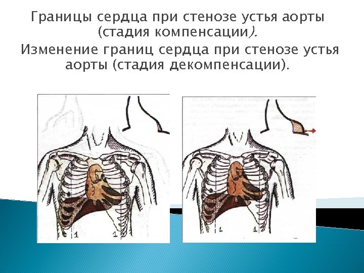 Границы сердца при стенозе устья аорты (стадия компенсации). Изменение границ сердца при стенозе устья