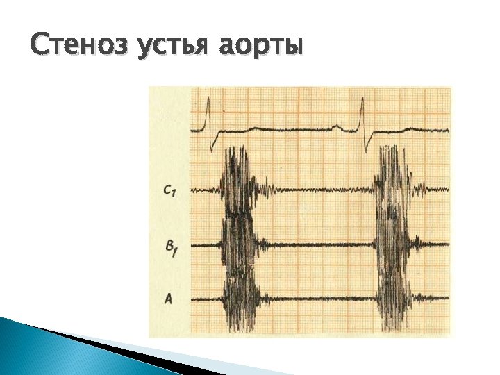 Стеноз устья аорты 
