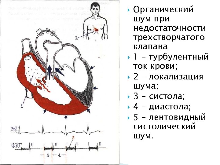  Органический шум при недостаточности трехстворчатого клапана 1 - турбулентный ток крови; 2 -