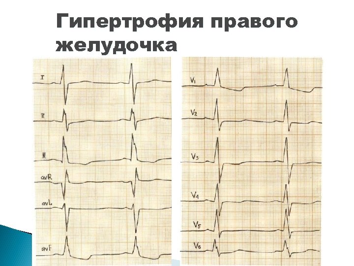 Гипертрофия правого желудочка 