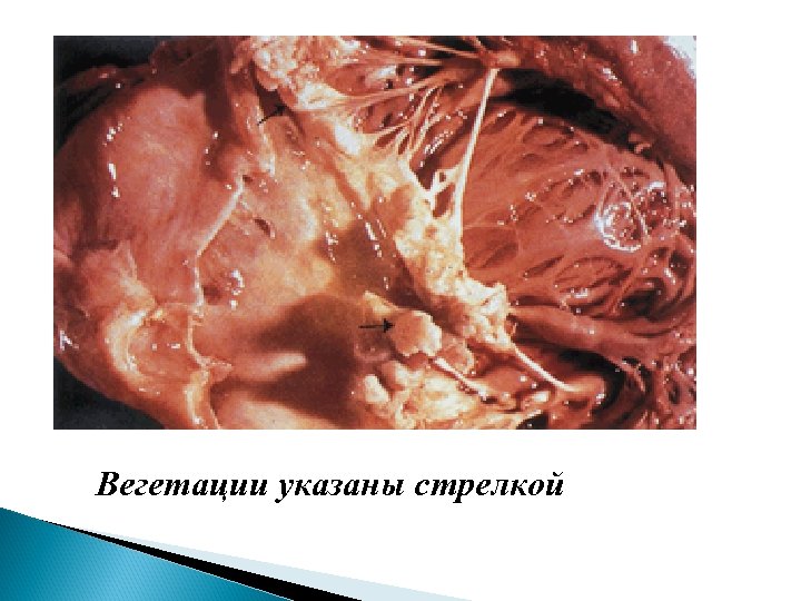 Вегетации указаны стрелкой 