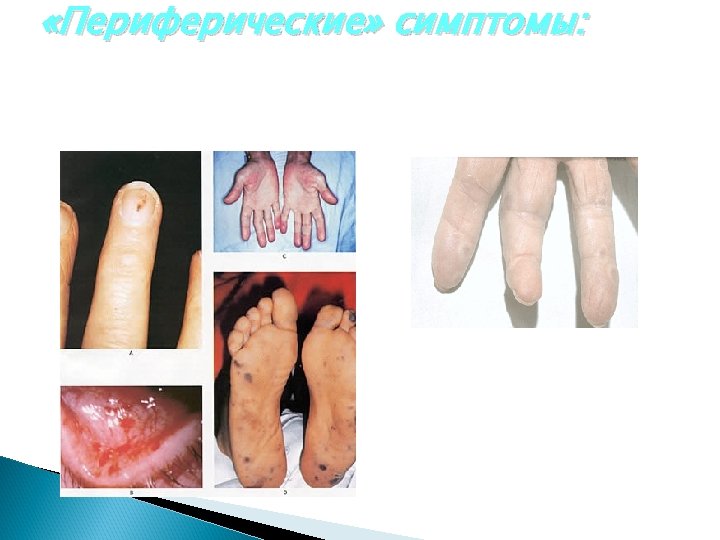  «Периферические» симптомы: 