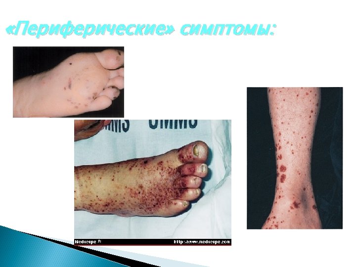  «Периферические» симптомы: 