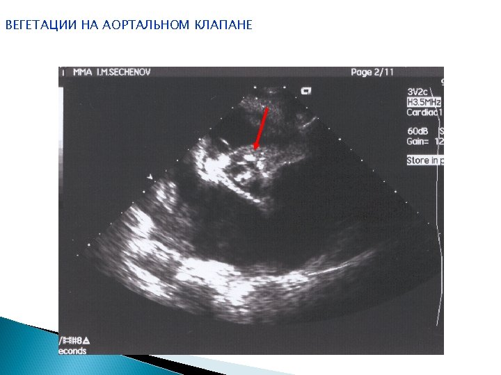 ВЕГЕТАЦИИ НА АОРТАЛЬНОМ КЛАПАНЕ 