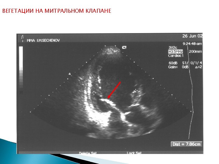ВЕГЕТАЦИИ НА МИТРАЛЬНОМ КЛАПАНЕ 