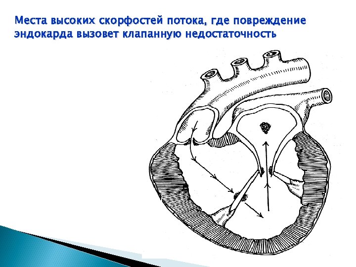 Места высоких скорфостей потока, где повреждение эндокарда вызовет клапанную недостаточность 