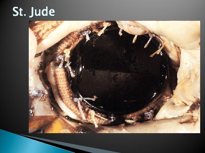 St. Jude 