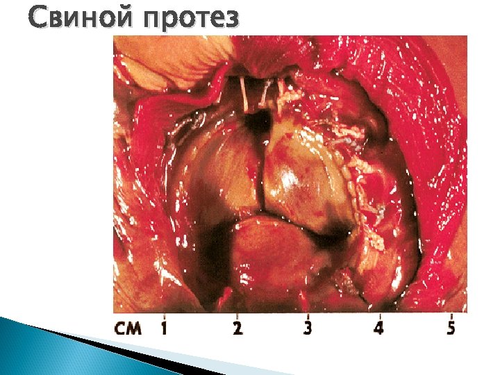 Свиной протез 