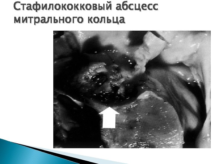 Стафилококковый абсцесс митрального кольца 