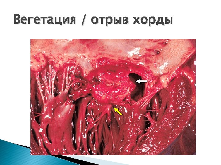Вегетация / отрыв хорды 