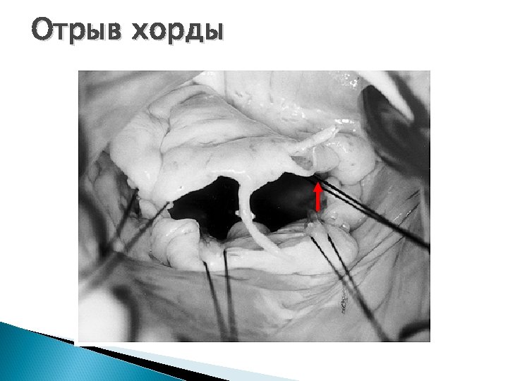 Отрыв хорды 