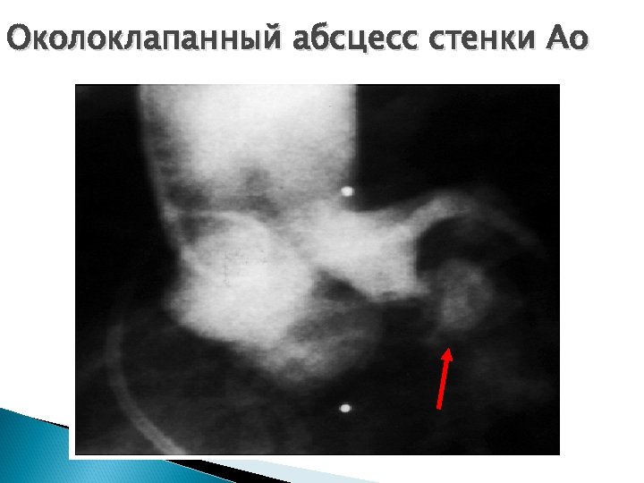 Околоклапанный абсцесс стенки Ао 