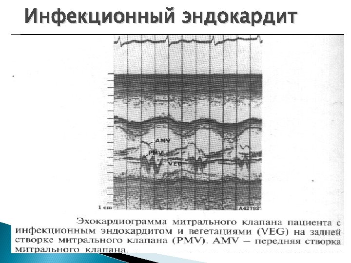 Инфекционный эндокардит 