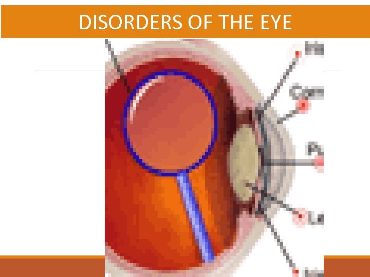 DISORDERS OF THE EYE 